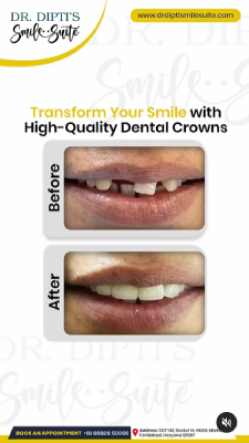 dental crown in faridabad
