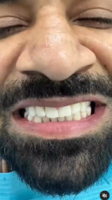 Philips Zoom Whitening Treatmen